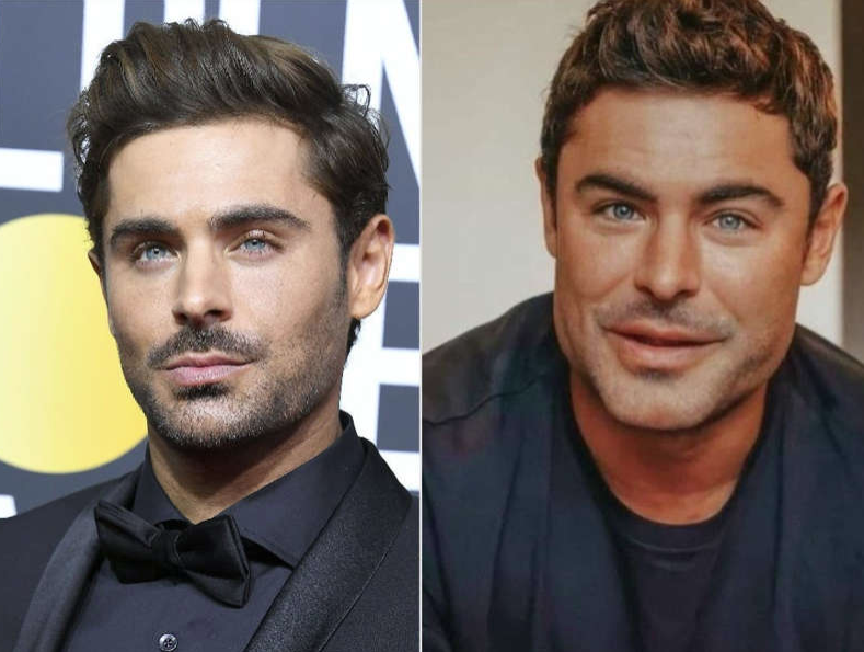 Zac Efron me nofull më të spikatur, faqe të fryra e buzë më të mëdha